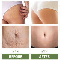 Crema Para Eliminar Estrías
