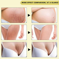 Crema Para Eliminar Estrías